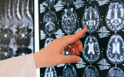 Sudden Unexpected Deaths in Epilepsy in Children in England: What can we learn?